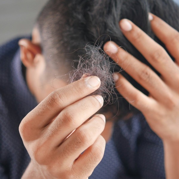 Hair Loss Causes & Diagnosis