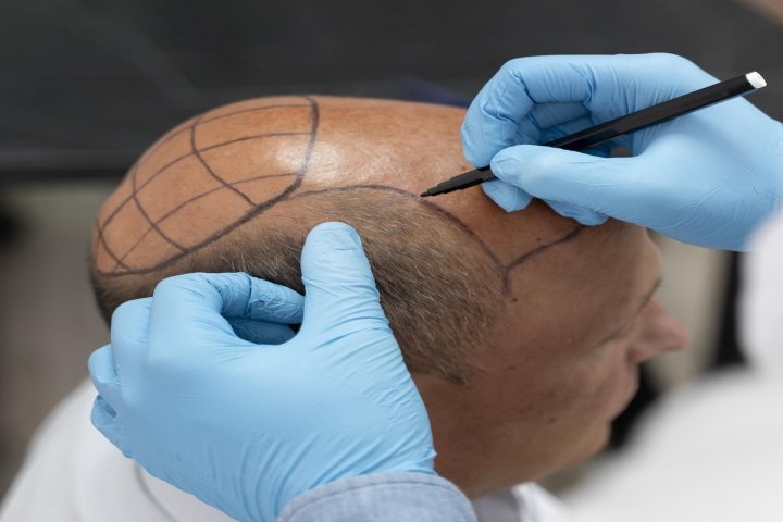 Hair Transplant category