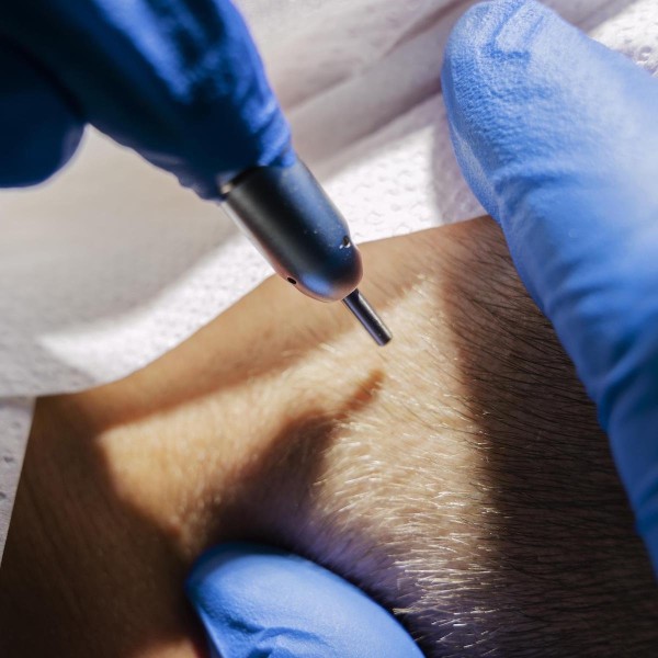 Hair Transplant Basics