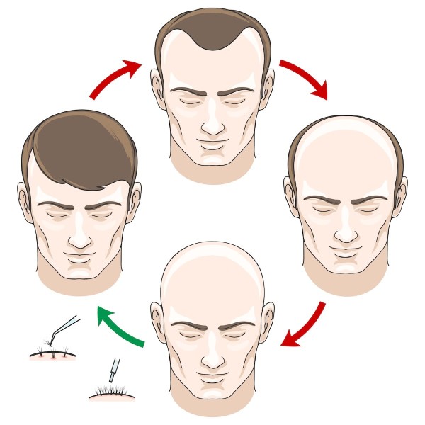 Male Pattern Baldness
