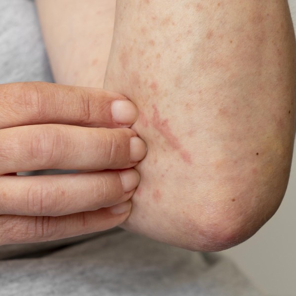 Symptoms and Diagnosis
