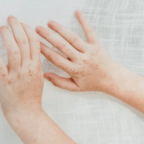 Types of Psoriasis