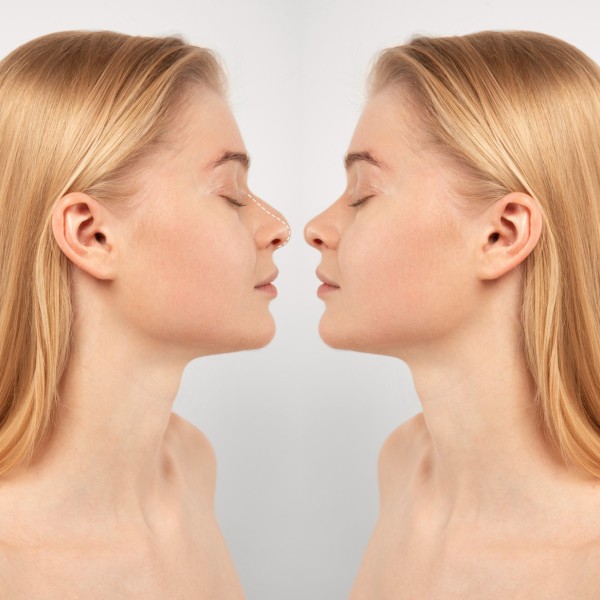 Types of Rhinoplasty