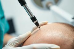 Close-up of a medical procedure, likely a hair transplant or micro-needling. A gloved hand holds a device near the patient's scalp. The focus is on precision and medical care.