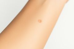 Close-up of a skin mole on a fair-skinned arm against a white background. Focus on a small, round, brown skin lesion, potentially for dermatology or skin health awareness. Skin condition, mole, dermatology, skin check.