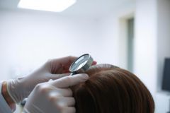 Close-up of a medical professional examining a patient's scalp with a magnifying glass. Focus on skin assessment, dermatology, and healthcare examination. Bright, clinical setting.