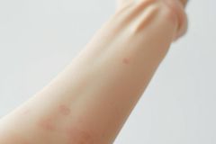 Close-up of a light skin arm showing red itchy rash or hives. The skin irritation is visible against a blurred white background, suggesting potential allergic reaction or insect bites. Focus on skin health and dermatology concerns.