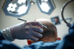 Close-up of a medical procedure, likely hair transplant or scalp treatment. A gloved hand holds a surgical instrument near a patient's head. Bright medical lighting illuminates the scene.
