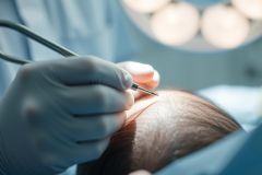 Close-up of a surgical procedure involving a gloved hand holding a medical instrument over a patient's head. The scene is brightly lit with surgical lights, showcasing a medical environment. Predominant colors are blue, white, and skin tones. Focus on precision and medical care.