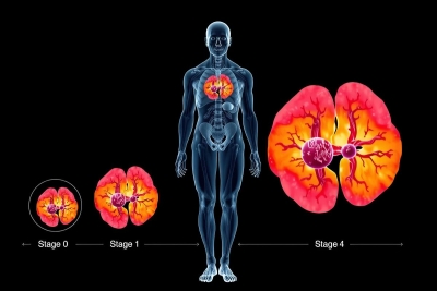 The image depicts a side by side comparison of the human anatomy. On the left is a silhouette of the human body from front to back, and on the right are three images representing stages of kidney disease progression from stage 0 to stage 3 as indicated by the arrows pointing upwards, with each image showing increasingly damaged and enlarged kidneys. The context suggests a health educational theme, highlighting organ deterioration in chronic diseases.