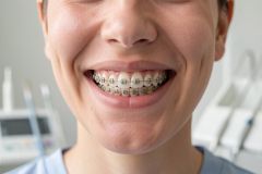 Young adult smiling in a dental clinic, showing orthodontic braces on upper and lower teeth.