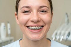 Young patient smiling in a dental chair, showing metal fixed braces on upper and lower teeth during orthodontic treatment.