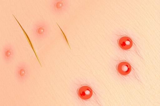 What Is Dermatitis?