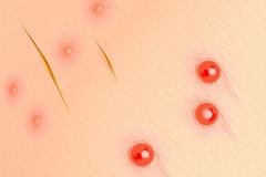 The image shows a close-up of skin with several red spots, which may indicate an infection or irritation. The top part of the image is cropped to show only the affected area on the skin. This medical condition is commonly referred to as impetigo.